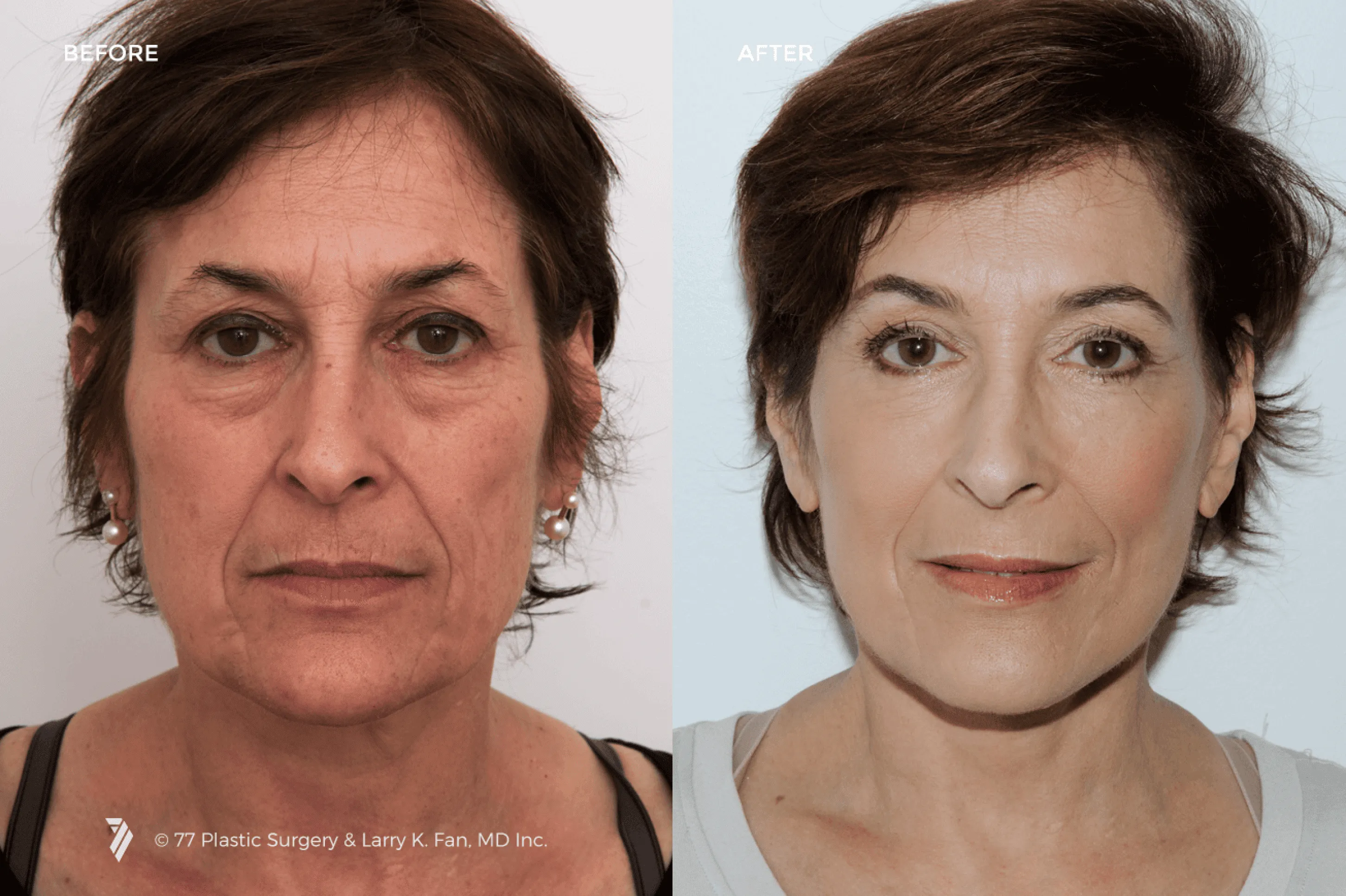 facelift